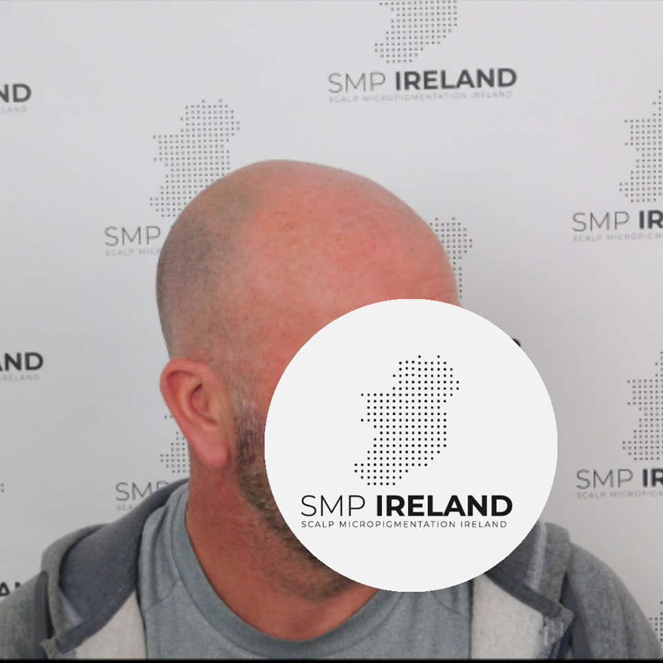 Scalp Micropigmentation is a pmu procedure that uses a method similar to a tattoo to replicate hair follicles on your scalp. No hair grows from this procedure.
At SMP Ireland:
We tailor each hairline to every individual client.
We restore the image of having a full head of hair
We only use the highest standard quality products to ensure you get the best look.
No bleeding, no swelling and no scabbing.
Any redness disappears within 24 hours.
Some of the things we tackle are the following:
Thinning hair
Receding hairlines
Add hair density
Create symmetry
Male pattern baldness
Female pattern baldness
Alopecia
Hair loss.
FUT and FUE scarring camouflage
If interested DM, text, call email or check my website for quotes.
All consultations are free and payment plans are available.
Please feel free to follow to see our customer transformations.
Based in Limerick city, Ireland serving Ireland.
#beboldnotbald #trusttheprocess #pmuireland #smpireland #limerickcity #limerick
#limerickbusiness #bald #hair #scalpmicropigmentationireland #hairloss #balding #beautyireland #aestheticireland #baldingsolutionireland #confidencerestored
#newyearnewyou #SixNations2025 #greathairline #thickerhair #localbusiness #irishownedbusiness