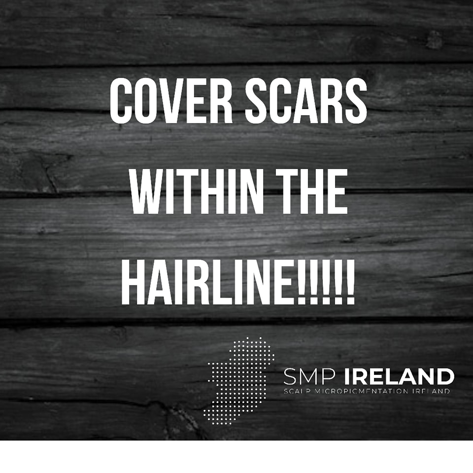 Scar camouflage with the hairline!!!!
Scalp Micropigmentation is a pmu procedure that uses a method similar to a tattoo to replicate hair follicles on your scalp. No hair grows from this procedure.
At SMP Ireland:
We tailor each hairline to every individual client.
We restore the image of having a full head of hair
We only use the highest standard quality products to ensure you get the best look.
No bleeding, no swelling and no scabbing.
Any redness disappears within 24 hours.
Some of the things we tackle are the following:
Thinning hair
Receding hairlines
Add hair density
Create symmetry
Male pattern baldness
Female pattern baldness
Alopecia
Hair loss.
FUT and FUE scarring camouflage
If interested DM, text, call email or check my website for quotes.
All consultations are free and payment plans are available.
Please feel free to follow to see our customer transformations.
Based in Limerick city, Ireland serving Ireland.
#beboldnotbald #trusttheprocess #pmuireland #smpireland #limerickcity #limerick
#limerickbusiness #bald #hair #scalpmicropigmentationireland #hairloss #balding #beautyireland #aestheticireland #baldingsolutionireland #confidencerestored
#newyearnewyou #SixNations2025 #greathairline #thickerhair #localbusiness #irishownedbusiness