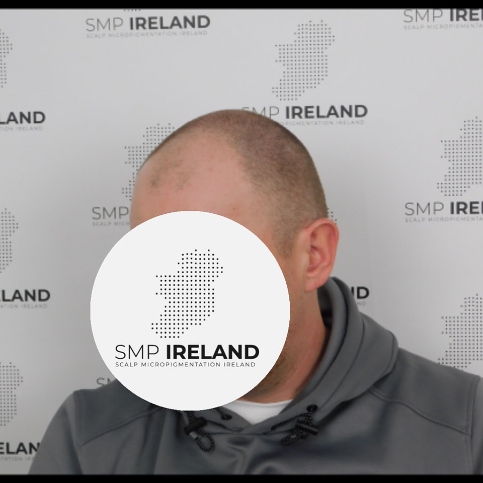 Subtle shaved head looks!!!!
Scalp Micropigmentation is a pmu procedure that uses a method similar to a tattoo to replicate hair follicles on your scalp. No hair grows from this procedure.
At SMP Ireland:
We tailor each hairline to every individual client.
We restore the image of having a full head of hair
We only use the highest standard quality products to ensure you get the best look.
No bleeding, no swelling and no scabbing.
Any redness disappears within 24 hours.
Some of the things we tackle are the following:
Thinning hair
Receding hairlines
Add hair density
Create symmetry
Male pattern baldness
Female pattern baldness
Alopecia
Hair loss.
FUT and FUE scarring camouflage
If interested DM, text, call email or check my website for quotes.
All consultations are free and payment plans are available.
Please feel free to follow to see our customer transformations.
Based in Limerick city, Ireland serving Ireland.
#beboldnotbald #trusttheprocess #pmuireland #smpireland #limerickcity #limerick
#limerickbusiness #bald #hair #scalpmicropigmentationireland #hairloss #balding #beautyireland #aestheticireland #baldingsolutionireland #confidencerestored