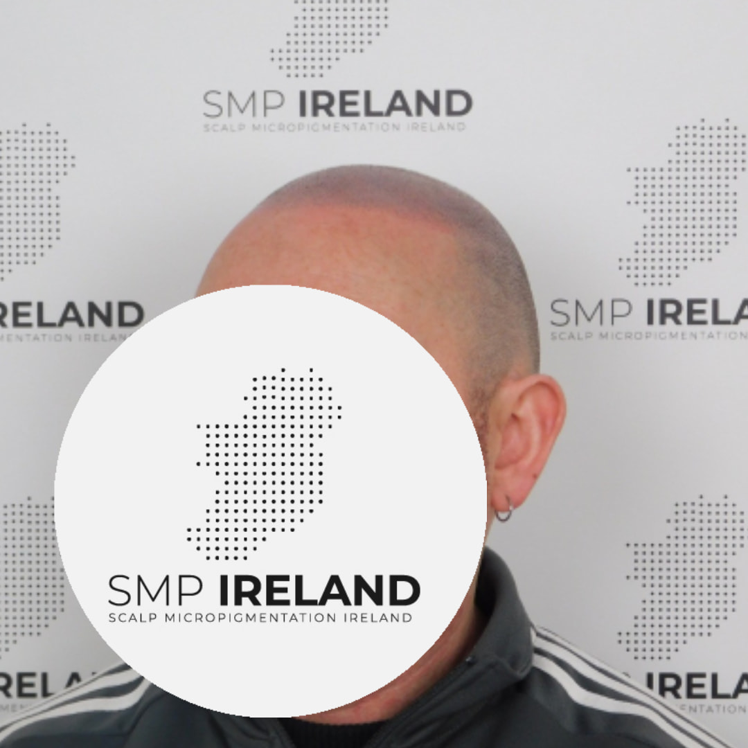 Confidence restored. Take years off your look !!!!!
Scalp Micropigmentation is a pmu procedure that uses a method similar to a tattoo to replicate hair follicles on your scalp. No hair grows from this procedure.
At SMP Ireland:
We tailor each hairline to every individual client.
We restore the image of having a full head of hair
We only use the highest standard quality products to ensure you get the best look.
No bleeding, no swelling and no scabbing.
Any redness disappears within 24 hours.
Some of the things we tackle are the following:
Thinning hair
Receding hairlines
Add hair density
Create symmetry
Male pattern baldness
Female pattern baldness
Alopecia
Hair loss.
FUT and FUE scarring camouflage
If interested DM, text, call email or check my website for quotes.
All consultations are free and payment plans are available.
Please feel free to follow to see our customer transformations.
Based in Limerick city, Ireland serving Ireland.
#beboldnotbald #trusttheprocess #pmuireland #smpireland #limerickcity #limerick
#limerickbusiness #bald #hair #scalpmicropigmentationireland #hairloss #balding #beautyireland #aestheticireland #baldingsolutionireland #confidencerestored
#timemachine #baldandbeautiful