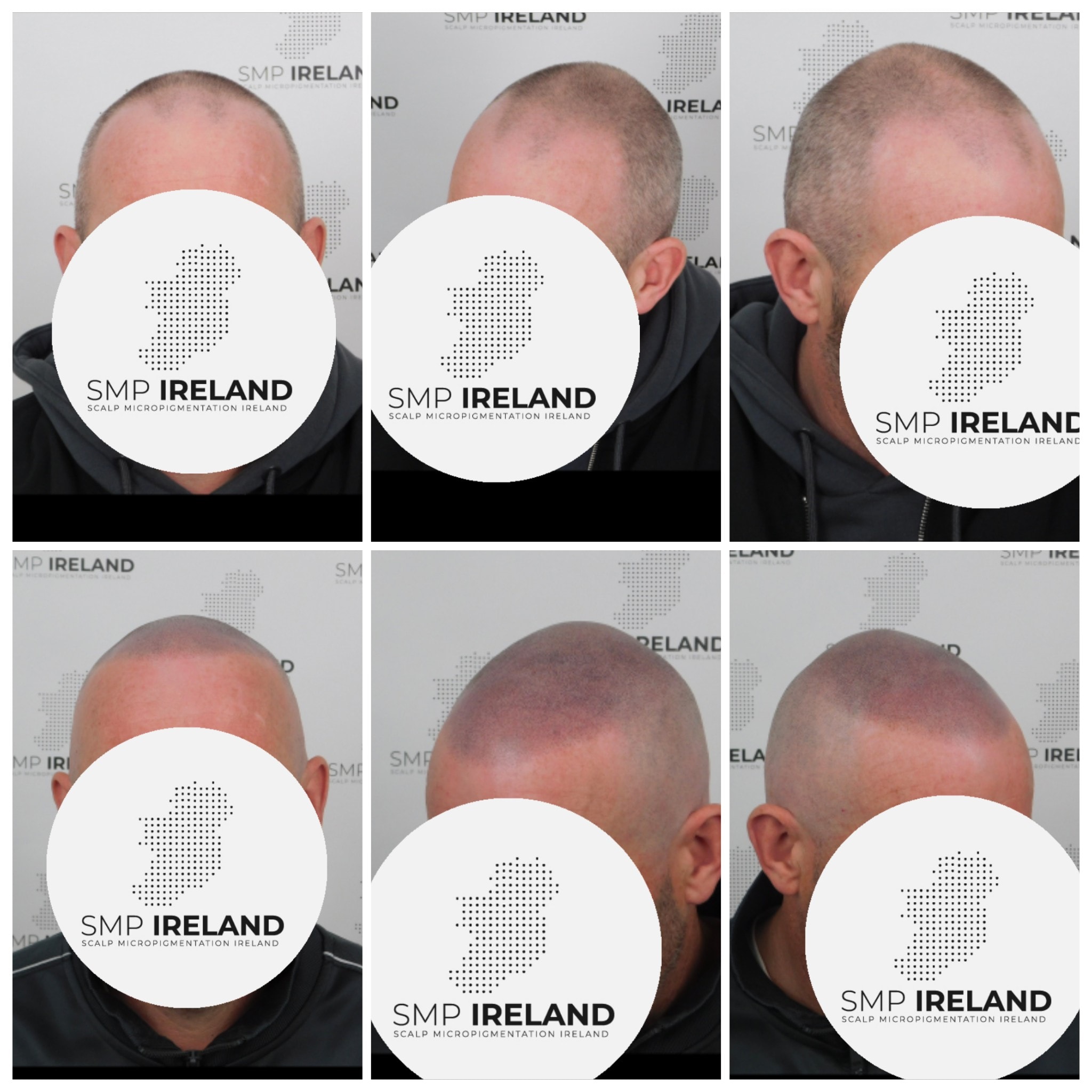 Shaved head look for the win!!!!!
Scalp Micropigmentation is a pmu procedure that uses a method similar to a tattoo to replicate hair follicles on your scalp. No hair grows from this procedure.
At SMP Ireland:
We tailor each hairline to every individual client.
We restore the image of having a full head of hair
We only use the highest standard quality products to ensure you get the best look.
No bleeding, no swelling and no scabbing.
Any redness disappears within 24 hours.
Some of the things we tackle are the following:
Thinning hair
Receding hairlines
Add hair density
Create symmetry
Male pattern baldness
Female pattern baldness
Alopecia
Hair loss.
FUT and FUE scarring camouflage
If interested DM, text, call email or check my website for quotes.
All consultations are free and payment plans are available.
Please feel free to follow to see our customer transformations.
Based in Limerick city, Ireland serving Ireland.
#beboldnotbald #trusttheprocess #pmuireland #smpireland #limerickcity #limerick
#limerickbusiness #bald #hair #scalpmicropigmentationireland #hairloss #balding #beautyireland #aestheticireland #baldingsolutionireland #confidencerestored
#winning #shavedheadlook