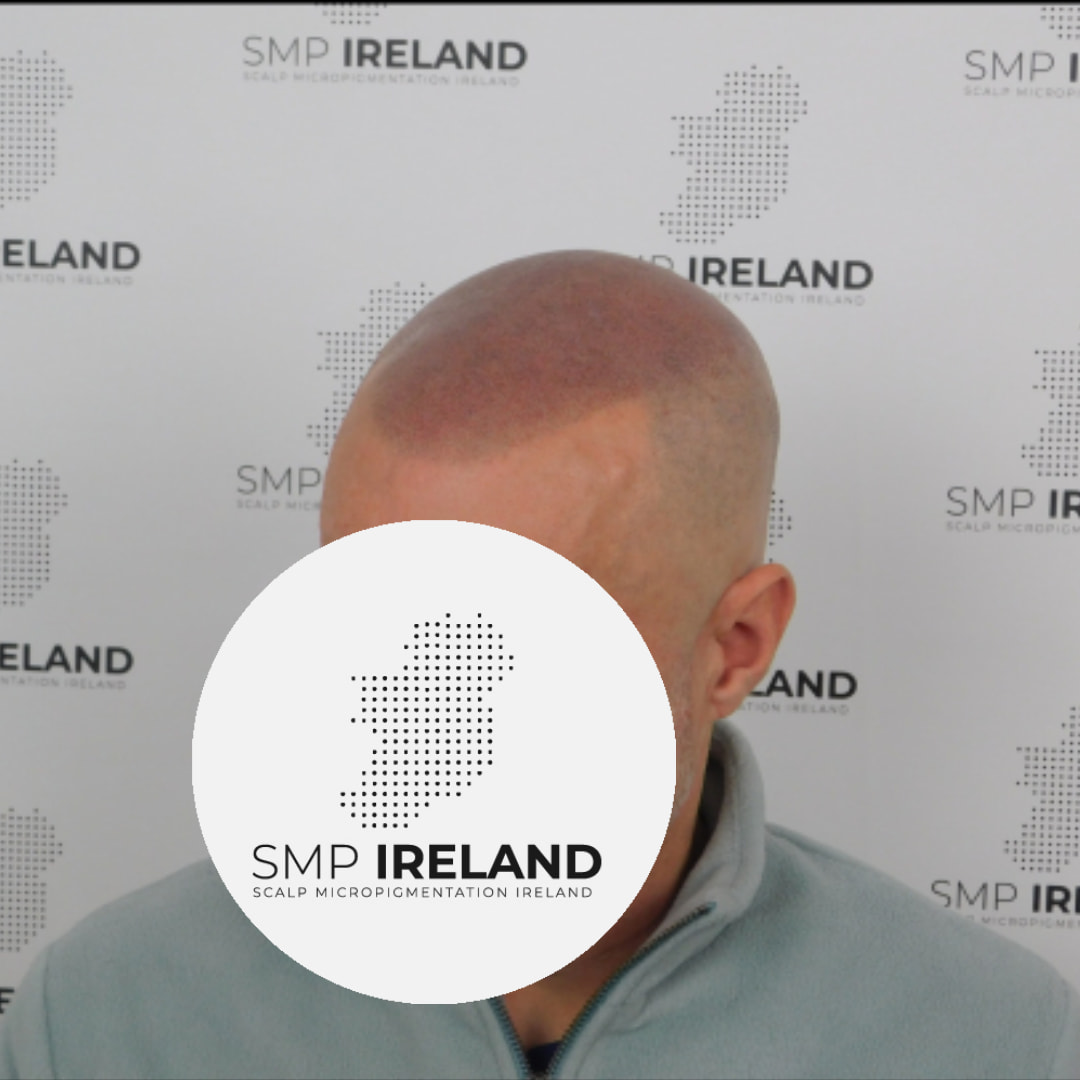Shaved head look top up. Done in 1 session!!!!
Scalp Micropigmentation is a pmu procedure that uses a method similar to a tattoo to replicate hair follicles on your scalp. No hair grows from this procedure.
At SMP Ireland:
We tailor each hairline to every individual client.
We restore the image of having a full head of hair
We only use the highest standard quality products to ensure you get the best look.
No bleeding, no swelling and no scabbing.
Any redness disappears within 24 hours.
Some of the things we tackle are the following:
Thinning hair
Receding hairlines
Add hair density
Create symmetry
Male pattern baldness
Female pattern baldness
Alopecia
Hair loss.
FUT and FUE scarring camouflage
If interested DM, text, call email or check my website for quotes.
All consultations are free and payment plans are available.
Please feel free to follow to see our customer transformations.
Based in Limerick city, Ireland serving Ireland.
#beboldnotbald #trusttheprocess #pmuireland #smpireland #limerickcity #limerick
#limerickbusiness #bald #hair #scalpmicropigmentationireland #hairloss #balding #beautyireland #aestheticireland #baldingsolutionireland #confidencerestored
#lookyounger #yearsyounger