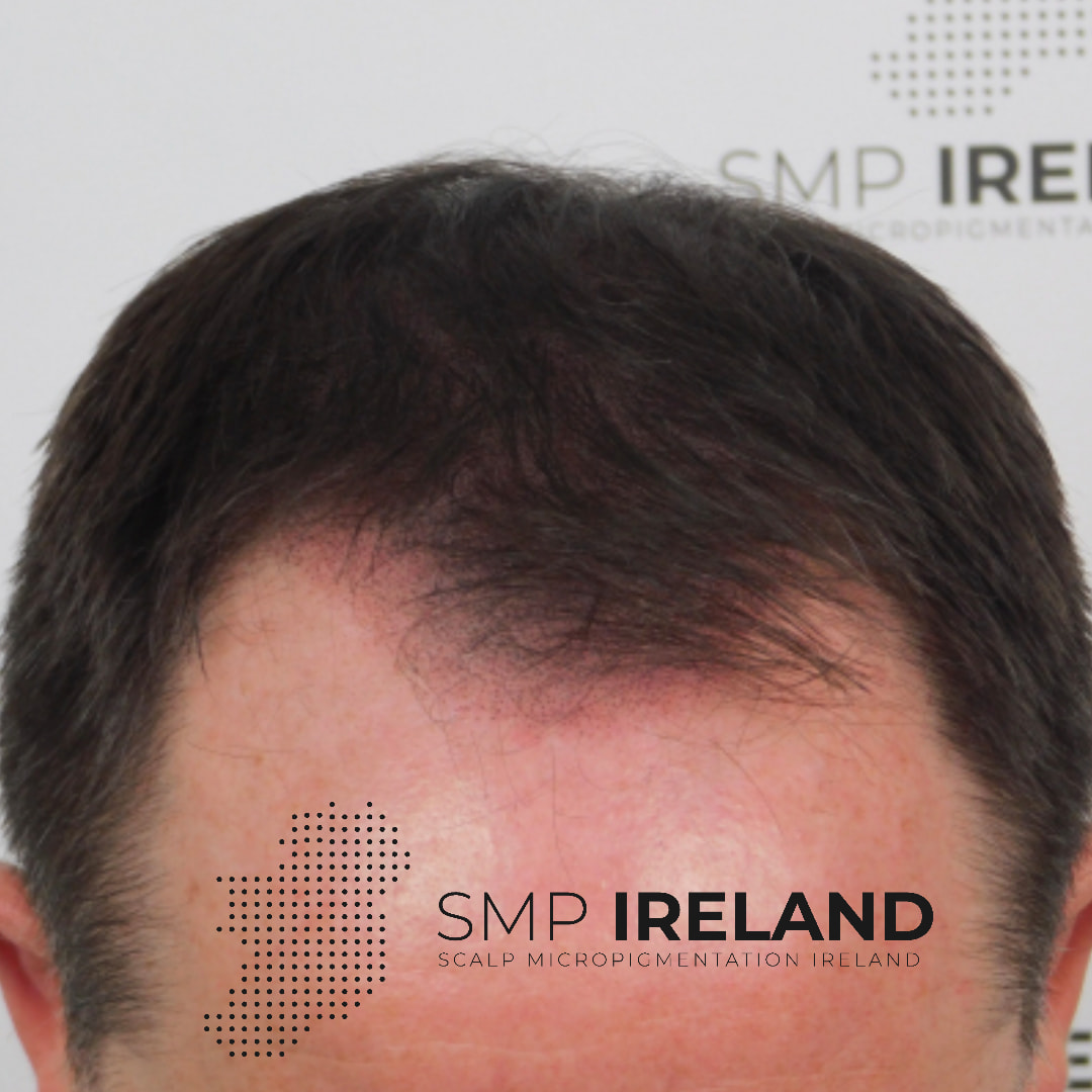 Add density to your thinning hair!!!!!
You don't need to shave your head.
Done in 3 sessions!!!!
Scalp Micropigmentation is a pmu procedure that uses a method similar to a tattoo to replicate hair follicles on your scalp. No hair grows from this procedure.
At SMP Ireland:
We tailor each hairline to every individual client.
We restore the image of having a full head of hair
We only use the highest standard quality products to ensure you get the best look.
No bleeding, no swelling and no scabbing.
Any redness disappears within 24 hours.
Some of the things we tackle are the following:
Thinning hair
Receding hairlines
Add hair density
Create symmetry
Male pattern baldness
Female pattern baldness
Alopecia
Hair loss.
FUT and FUE scarring camouflage
If interested DM, text, call email or check my website for quotes.
All consultations are free and payment plans are available.
Please feel free to follow to see our customer transformations.
Based in Limerick city, Ireland serving Ireland.
#beboldnotbald #trusttheprocess #pmuireland #smpireland #limerickcity #limerick
#limerickbusiness #bald #hair #scalpmicropigmentationireland #hairloss #balding #beautyireland #aestheticireland #baldingsolutionireland #confidencerestored
#thickerlookinghair
#youngagain