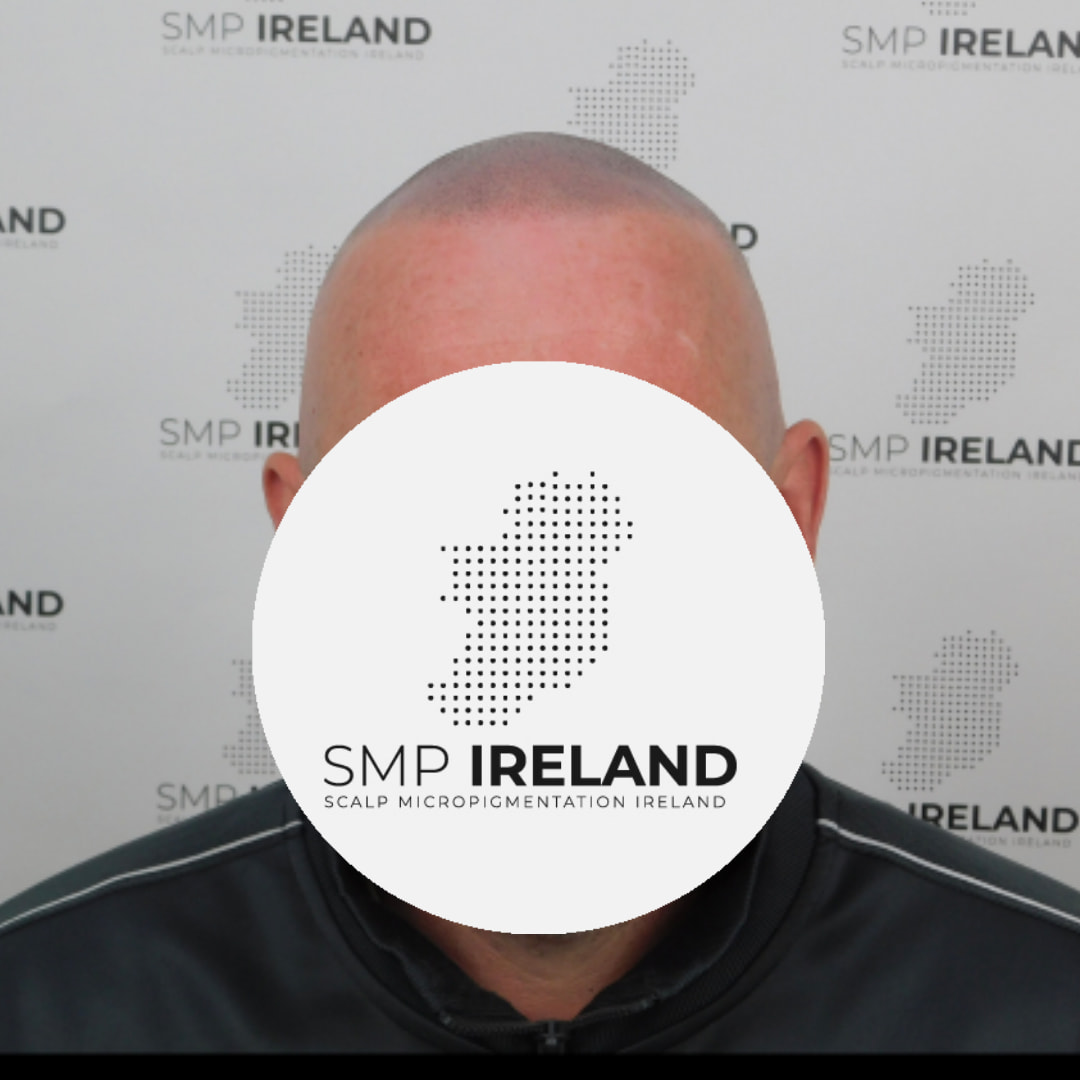 Subtle but effective!!!!
Scalp Micropigmentation is a pmu procedure that uses a method similar to a tattoo to replicate hair follicles on your scalp. No hair grows from this procedure.
At SMP Ireland:
We tailor each hairline to every individual client.
We restore the image of having a full head of hair
We only use the highest standard quality products to ensure you get the best look.
No bleeding, no swelling and no scabbing.
Any redness disappears within 24 hours.
Some of the things we tackle are the following:
Thinning hair
Receding hairlines
Add hair density
Create symmetry
Male pattern baldness
Female pattern baldness
Alopecia
Hair loss.
FUT and FUE scarring camouflage
If interested DM, text, call email or check my website for quotes.
All consultations are free and payment plans are available.
Please feel free to follow to see our customer transformations.
Based in Limerick city, Ireland serving Ireland.
#beboldnotbald #trusttheprocess #pmuireland #smpireland #limerickcity #limerick
#limerickbusiness #bald #hair #scalpmicropigmentationireland #hairloss #balding #beautyireland #aestheticireland #baldingsolutionireland #confidencerestored
#beauty #hairline #hairstyles #baldisbeautiful #thinninghair #thinninghairsolution #subtlebuteffective
