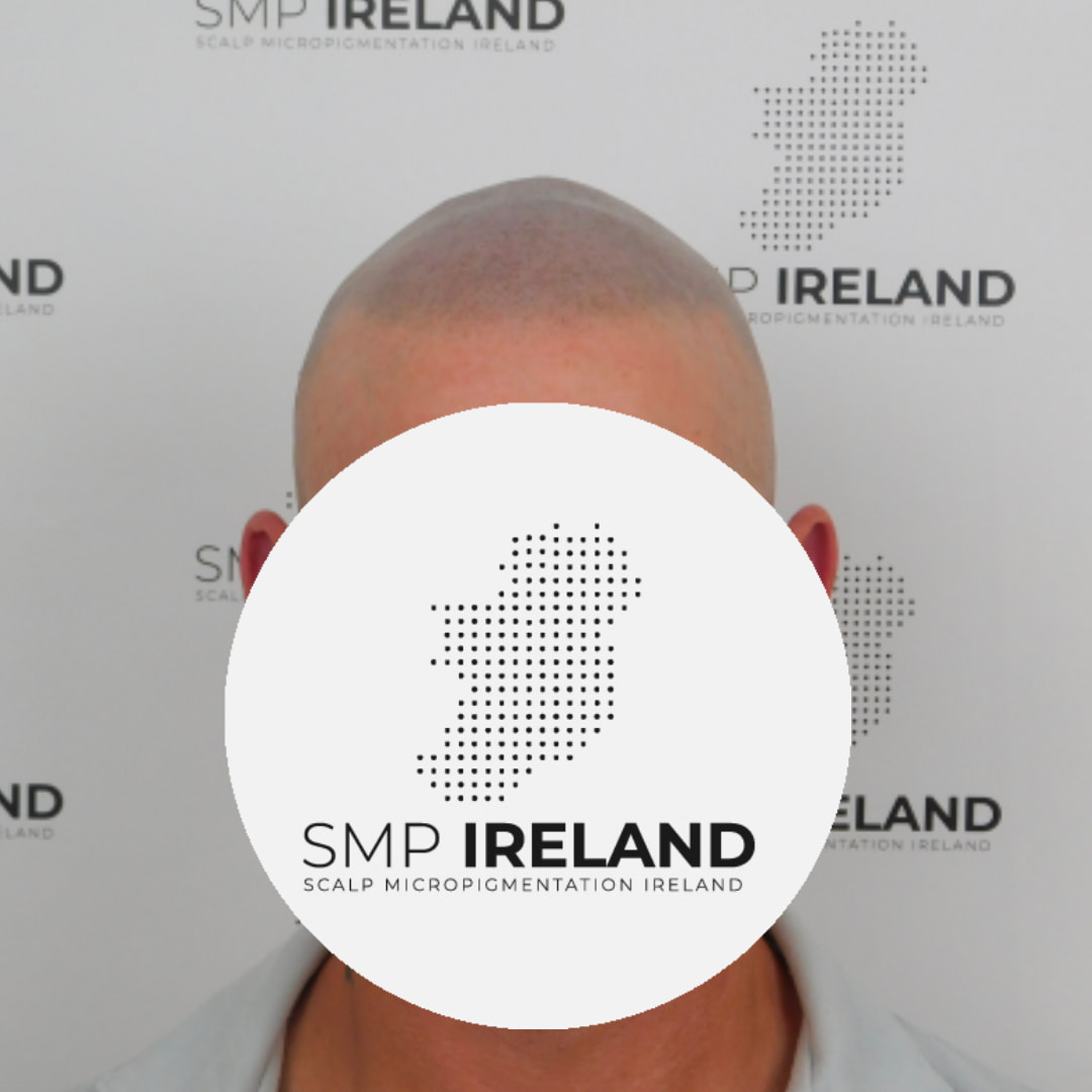 Love a good shaved head!!!!
Scalp Micropigmentation is a pmu procedure that uses a method similar to a tattoo to replicate hair follicles on your scalp. No hair grows from this procedure.
At SMP Ireland:
We tailor each hairline to every individual client.
We restore the image of having a full head of hair
We only use the highest standard quality products to ensure you get the best look.
No bleeding, no swelling and no scabbing.
Any redness disappears within 24 hours.
Some of the things we tackle are the following:
Thinning hair
Receding hairlines
Add hair density
Create symmetry
Male pattern baldness
Female pattern baldness
Alopecia
Hair loss.
FUT and FUE scarring camouflage
If interested DM, text, call email or check my website for quotes.
All consultations are free and payment plans are available.
Please feel free to follow to see our customer transformations.
Based in Limerick city, Ireland serving Ireland.
#beboldnotbald #trusttheprocess #pmuireland #smpireland #limerickcity #limerick
#limerickbusiness #bald #hair #scalpmicropigmentationireland #hairloss #balding #beautyireland #aestheticireland #baldingsolutionireland #confidencerestored
#beauty #hairline #hairstyle #baldisbeautiful #thinninghair #thinninghairsolution #shovelhead #shavedhead