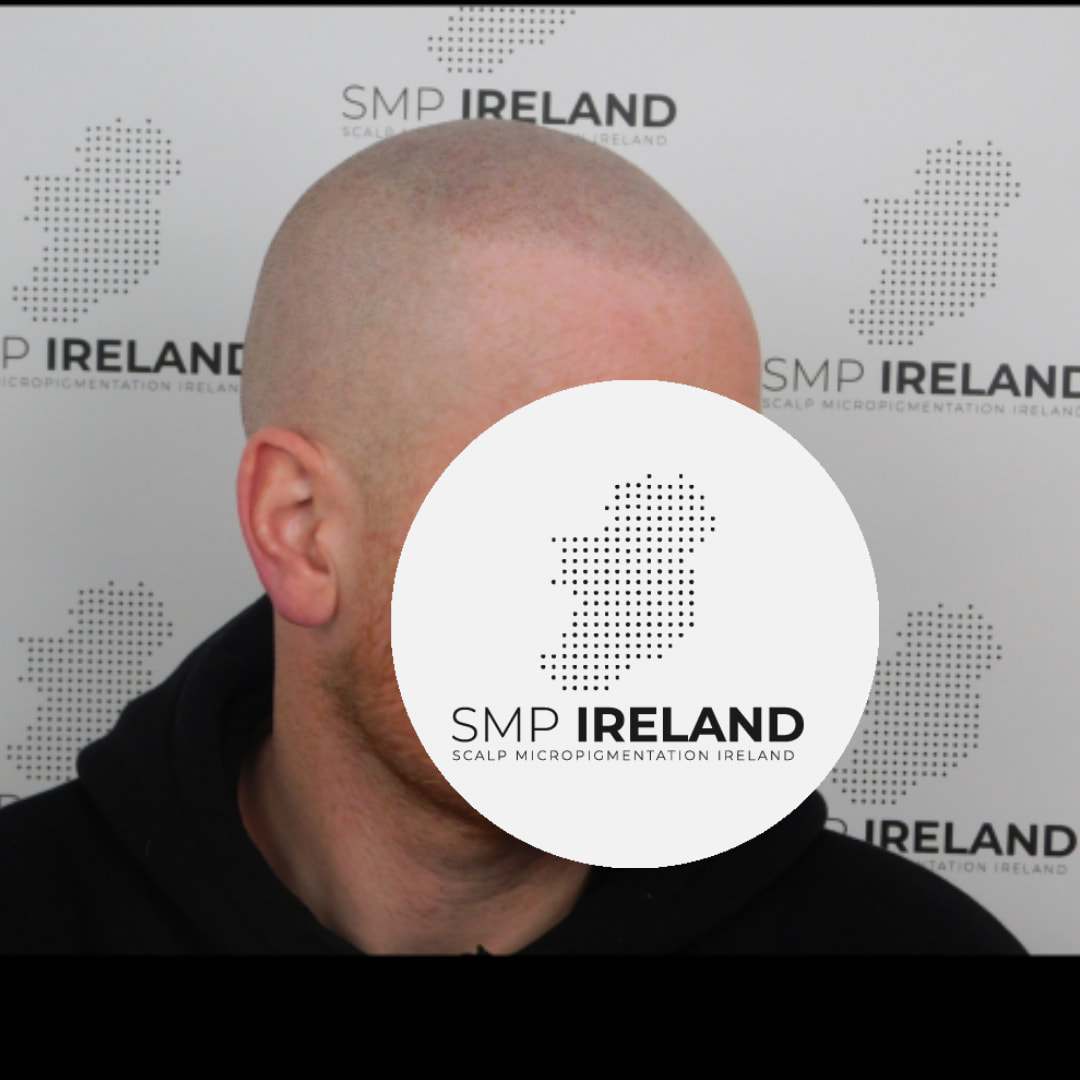 Lovely hairline restored.
Don't worry the redness fades in 24 - 48 hrs worst case scenario. Most of the time it's gone in a few hours.
Scalp Micropigmentation is a pmu procedure that uses a method similar to a tattoo to replicate hair follicles on your scalp. No hair grows from this procedure.
At SMP Ireland:
We tailor each hairline to every individual client.
We restore the image of having a full head of hair
We only use the highest standard quality products to ensure you get the best look.
No bleeding, no swelling and no scabbing.
Any redness disappears within 24 hours.
Some of the things we tackle are the following:
Thinning hair
Receding hairlines
Add hair density
Create symmetry
Male pattern baldness
Female pattern baldness
Alopecia
Hair loss.
FUT and FUE scarring camouflage
If interested DM, text, call email or check my website for quotes.
All consultations are free and payment plans are available.
Please feel free to follow to see our customer transformations.
Based in Limerick city, Ireland serving Ireland.
#beboldnotbald #trusttheprocess #pmuireland #smpireland #limerickcity #limerick
#limerickbusiness #bald #hair #scalpmicropigmentationireland #hairloss #balding #beautyireland #aestheticireland #baldingsolutionireland #confidencerestored
#beauty #hairline #hairstyles