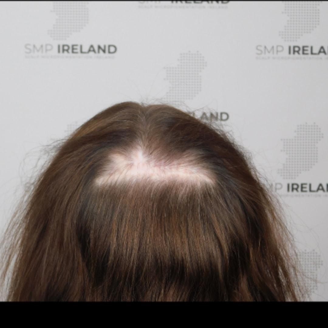 Covering an old scar.
Scalp Micropigmentation is a pmu procedure that uses a method similar to a tattoo to replicate hair follicles on your scalp. No hair grows from this procedure.
At SMP Ireland:
We tailor each hairline to every individual client.
We restore the image of having a full head of hair
We only use the highest standard quality products to ensure you get the best look.
No bleeding, no swelling and no scabbing.
Any redness disappears within 24 hours.
Some of the things we tackle are the following:
Thinning hair
Receding hairlines
Add hair density
Create symmetry
Male pattern baldness
Female pattern baldness
Alopecia
Hair loss.
FUT and FUE scarring camouflage
If interested DM, text, call email or check my website for quotes.
All consultations are free and payment plans are available.
Please feel free to follow to see our customer transformations.
Based in Limerick city, Ireland serving Ireland.
#beboldnotbald #trusttheprocess #pmuireland #smpireland #limerickcity #limerick
#limerickbusiness #bald #hair #scalpmicropigmentationireland #hairloss #balding #beautyireland #aestheticireland #baldingsolutionireland #confidencerestored
#beauty #hairline #hairstyles #baldisbeautiful #thinninghair #thinninghairsolution