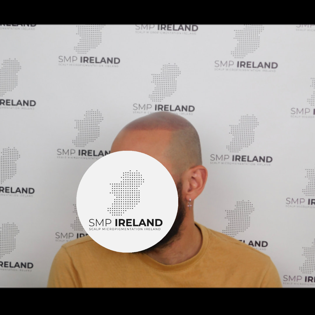 Super natural hairline for this Brazilian gent!!!!!
SMP can be applied to all ethnicities and complexions!!!
Scalp Micropigmentation is a pmu procedure that uses a method similar to a tattoo to replicate hair follicles on your scalp. No hair grows from this procedure.
At SMP Ireland:
We tailor each hairline to every individual client.
We restore the image of having a full head of hair
We only use the highest standard quality products to ensure you get the best look.
No bleeding, no swelling and no scabbing.
Any redness disappears within 24 hours.
Some of the things we tackle are the following:
Thinning hair
Receding hairlines
Add hair density
Create symmetry
Male pattern baldness
Female pattern baldness
Alopecia
Hair loss.
FUT and FUE scarring camouflage
If interested DM, text, call email or check my website for quotes.
All consultations are free and payment plans are available.
Please feel free to follow to see our customer transformations.
Based in Limerick city, Ireland serving Ireland.
#beboldnotbald #trusttheprocess #pmuireland #smpireland #limerickcity #limerick
#limerickbusiness #bald #hair #scalpmicropigmentationireland #hairloss #balding #beautyireland #aestheticireland #baldingsolutionireland #confidencerestored
#beauty #hairline #hairstyles #baldisbeautiful #thinninghair #thinninghairsolution