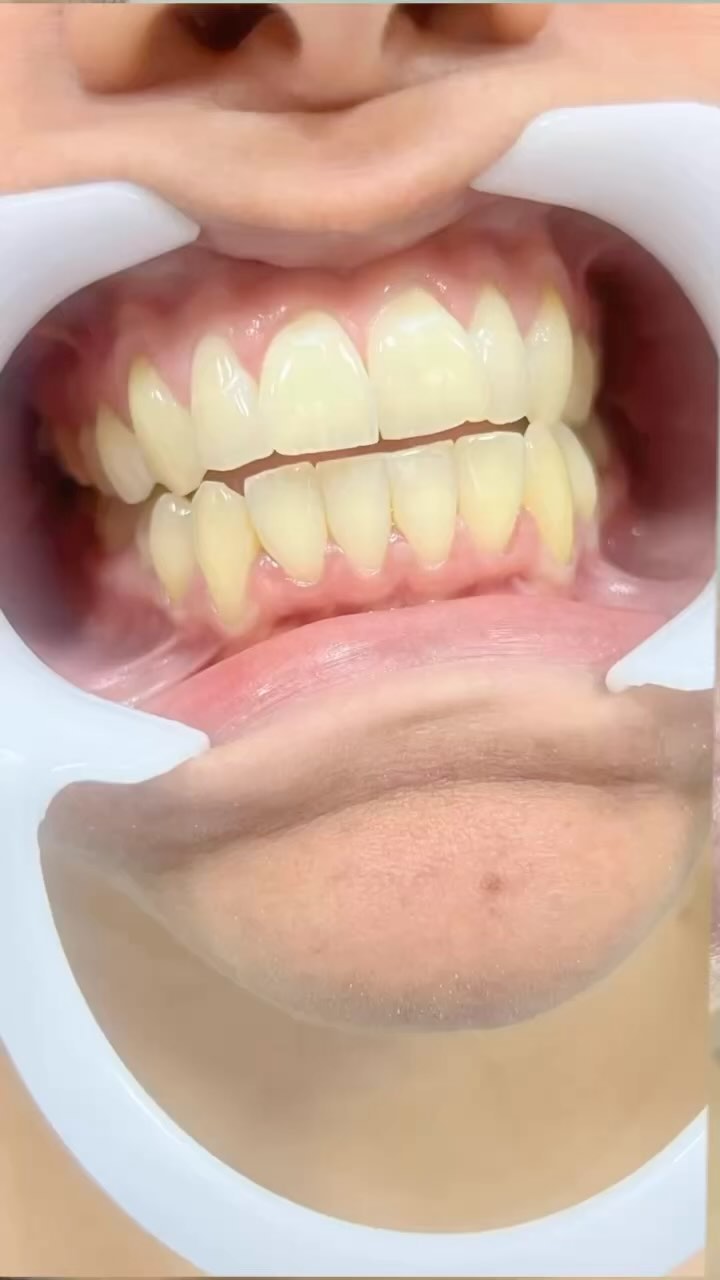 Nosso claramento dental é seguro e proporciona resultados duradouros. A nossa técnica não prejudica a saúde dos dentes e garante um sorriso mais branco por muito tempo.
Dentes brancos e saudáveis!
🦷✨