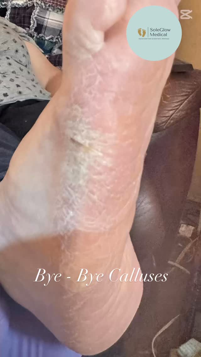 Thick, painful calluses? Not anymore!
With just one professional foot care session, this client walked away with smoother, healthier feet — and a lot more comfort. 🙌💖
Calluses can build up over time due to pressure, friction, or improper footwear — but with the right treatment and guidance, they don’t have to hold you back.
✅ Pain-free treatment
✅ Expert care by a Licensed Nurse
✅ Education on prevention & foot health
📍 Edmonton & surrounding areas
📲 Book your mobile visit today!
📞 780-655-5084
📧 info@soleglowmedical.com
🌐 www.soleglowmedical.com
✨ Healthy feet = happy steps.
#CallusRemoval #FootCareTransformation #EdmontonFootCare #BeforeAndAfterFeet #SoleGlowMedical #MedicalPedicure #NurseLedCare #CallusTreatment