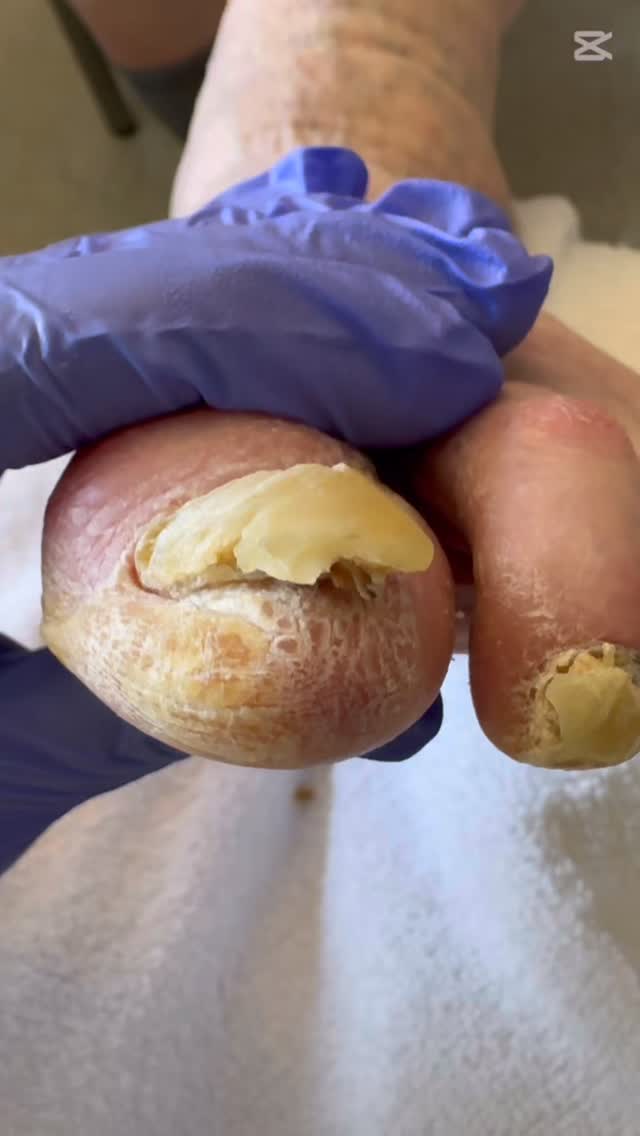 This diabetic client had never received proper foot care before and was recently admitted to the hospital.
With gentle hands and sterile instruments, I carefully debrided the thickened, fungal nails and ended the session with a relaxing foot massage.
She couldn’t thank me enough — overwhelmed with joy and comfort after finally receiving the foot care she deserved. 💙
📍 SoleGlow Medical – Compassionate, professional foot care at your doorstep.
📞 780-655-5084 | 💌 info@soleglowmedical.com
#MedicalFootCare #DiabeticFootCare #FootCareNurse #BeforeAndAfter #SoleGlowMedical #EdmontonNurse #MobileFootCare