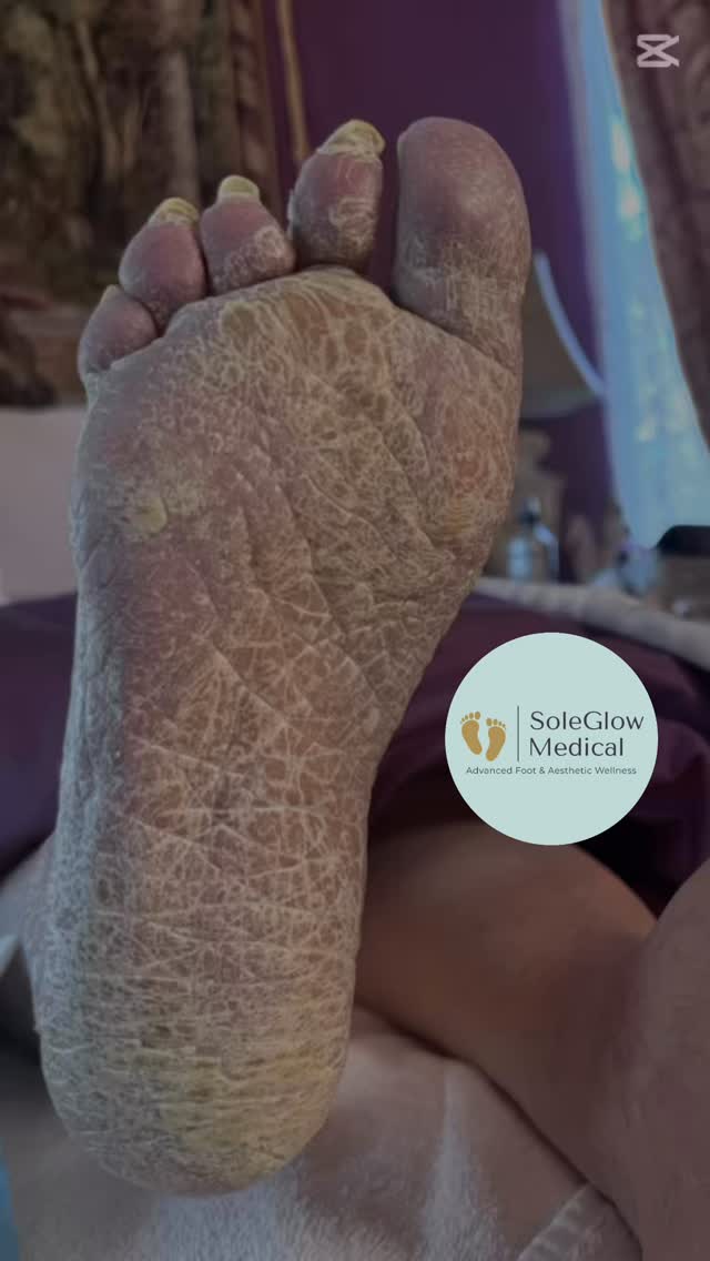 One Visit. Big Difference 
Thick calluses and layers of dead skin can make every step uncomfortable. But in just one appointment, you can feel the relief and see the results. 👏
Our mobile foot care services help restore comfort, improve skin health, and leave your feet feeling light again. 💙#soleglowmedical #mobilefootcare #footcarenurse #edmontonnurse #healthyfeet #healthyfeethappylife #beforeandafter 
📅 Book your visit today — your feet will thank you!
📍 Serving Edmonton
📞 780-655-5084
🌐 soleglowmedical.com