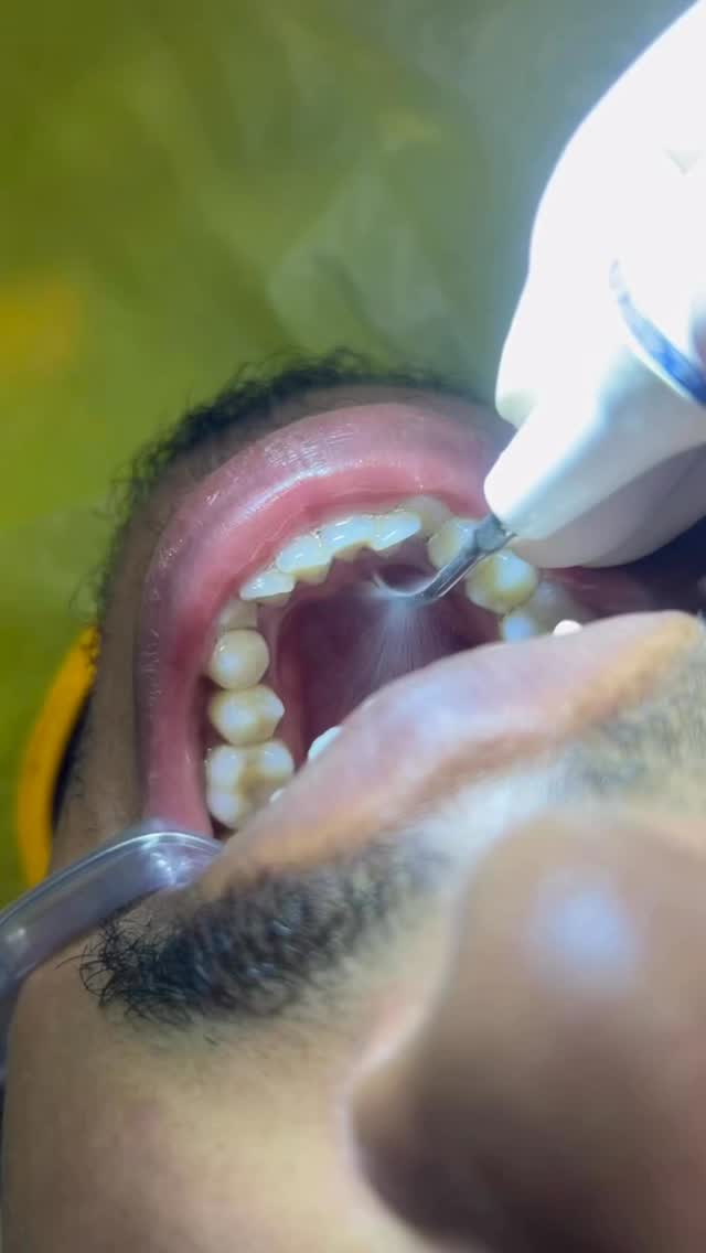 Você só lembra do dentista quando dói?
Quando chega nesse ponto, o problema ja avançou.
Gengivite e periodontite começam silenciosas...
Mas deixam marcas sérias.
Prevenir ainda é o melhor caminho.
AGENDE A SUA LIMPEZA 🦷✨