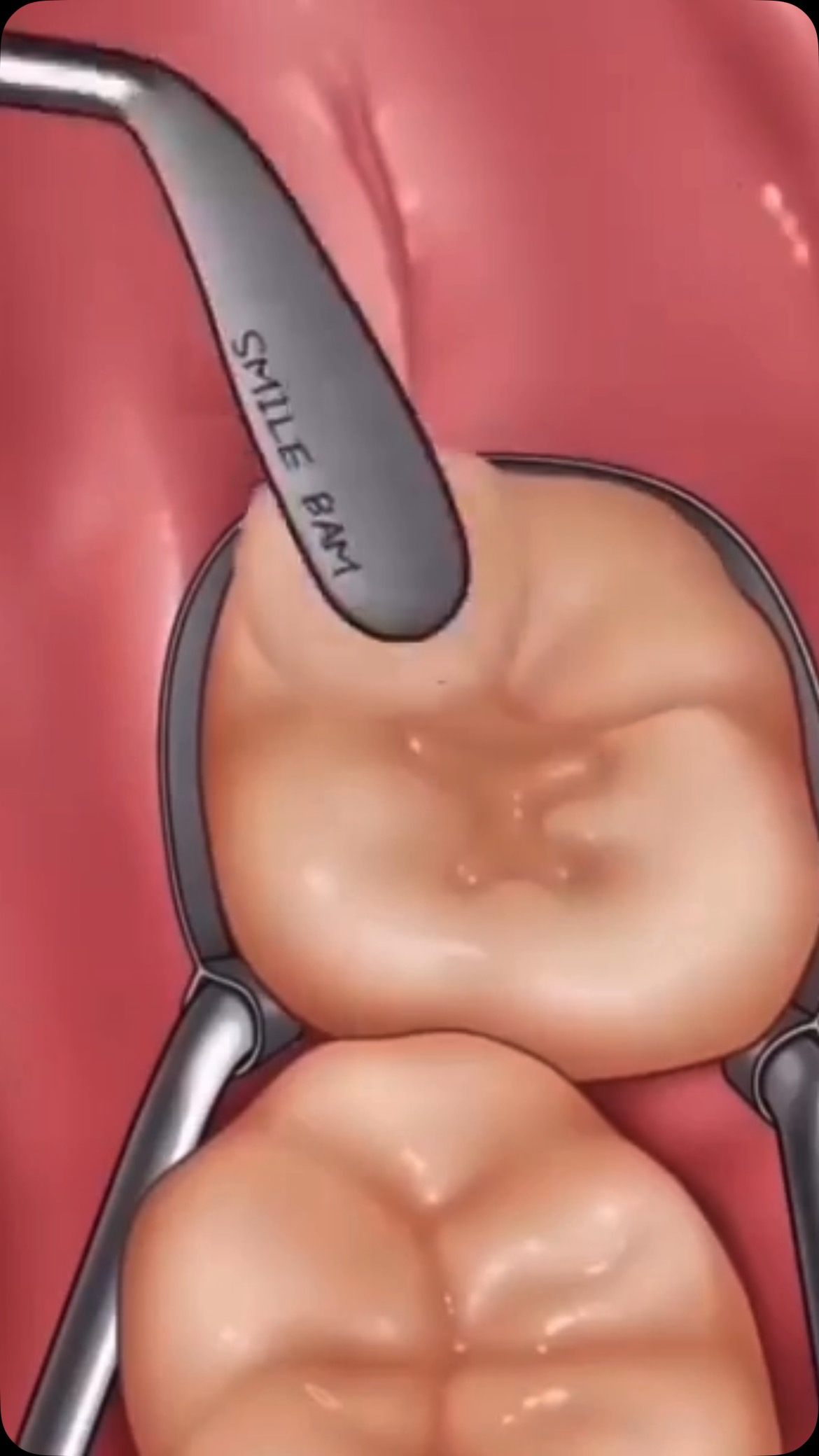 Nunca é só colocar uma massinha!
A remoção do tecido cariado e o preparo da cavidade para uma restauração de sucesso, exige técnica, cuidados, e a seleção de um bom material restaurador. Assim temos longevidade, função e estética devolvida.
🦷✨