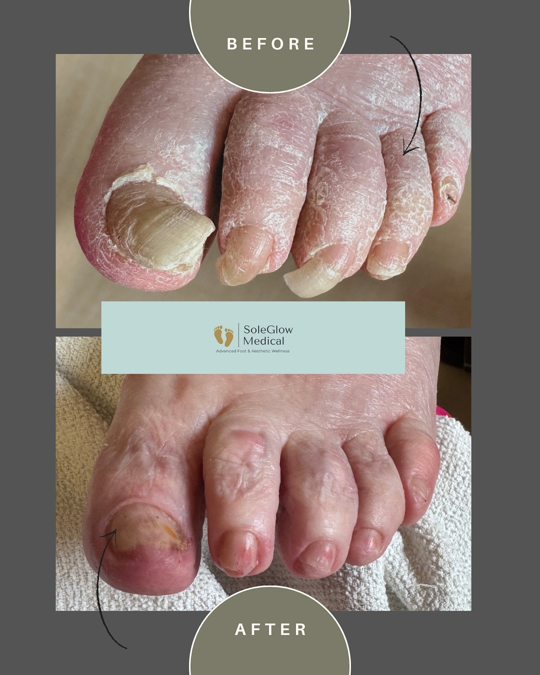 From overgrown to beautifully cared for — a true transformation.
This is what can happen when regular foot care is missed, especially for our seniors. But that’s exactly why we’re here.
At SoleGlow Medical Inc., we specialize in gentle, consistent foot care for seniors — right in the comfort of their own homes. Because no one should have to struggle with painful or neglected feet.
We’re here to help. Always.
Book your mobile foot care appointment today.
www.soleglowmedical.com
#SeniorFootCare #MobileNurse #HealthyFeet #SoleGlowMedical #FootCareNurse #BeforeAndAfter #CompassionateCare
