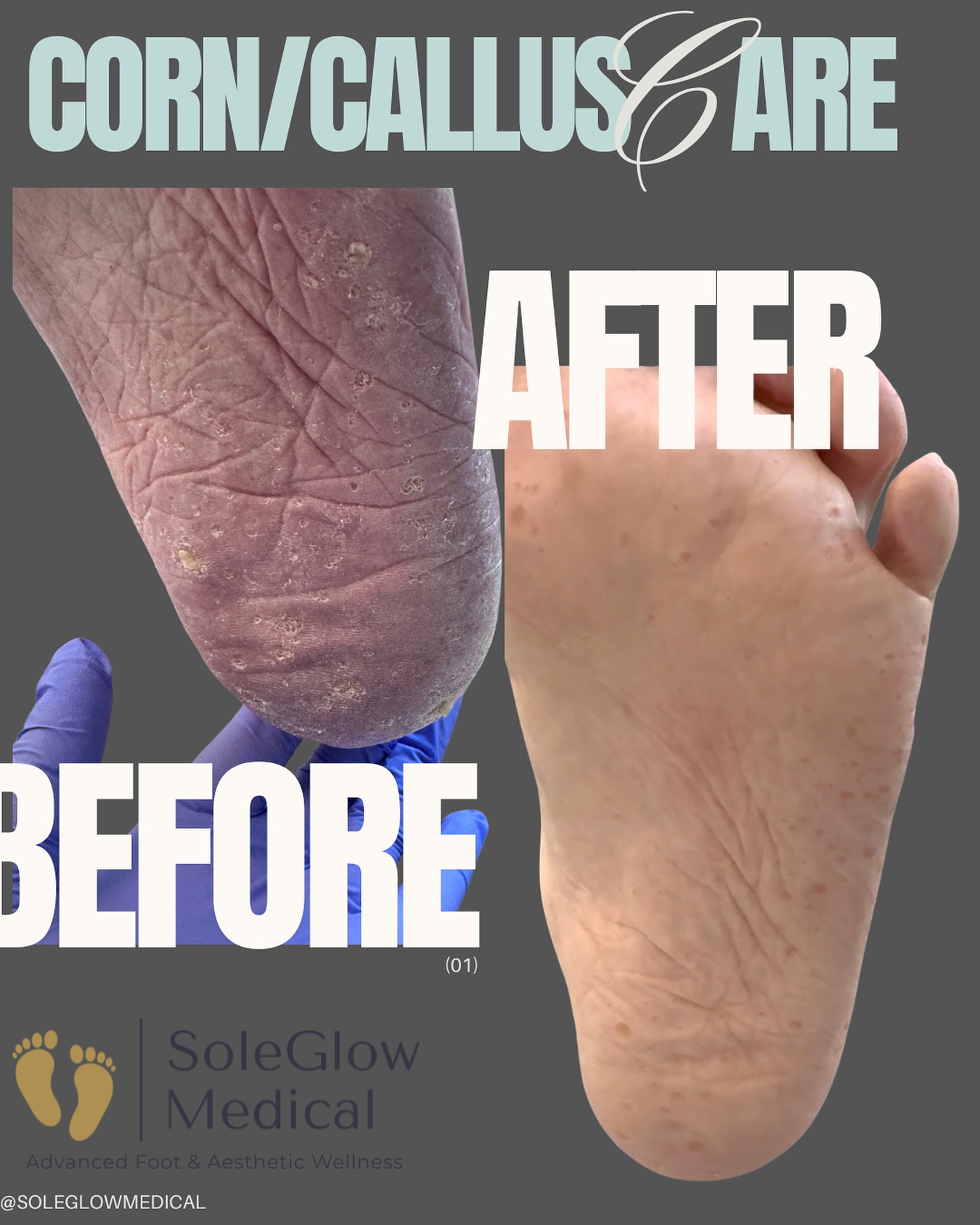 👣 Real Results: Corn & Callus Care
Thick, painful buildup on the soles—gone in one session!
This client came in with layers of corns and calluses causing daily discomfort. After gentle, professional care, their feet are smoother, healthier, and pain-free.
✨ Safe. Sterile. Effective.
📍 Medical foot care by a Registered Nurse
🚐 Mobile service across Edmonton
Your feet deserve real care—and real results.
#RealResults #SoleGlowMedical #CallusCare #CornRemoval #FootCareNurse #HealthyFeetEdmonton
