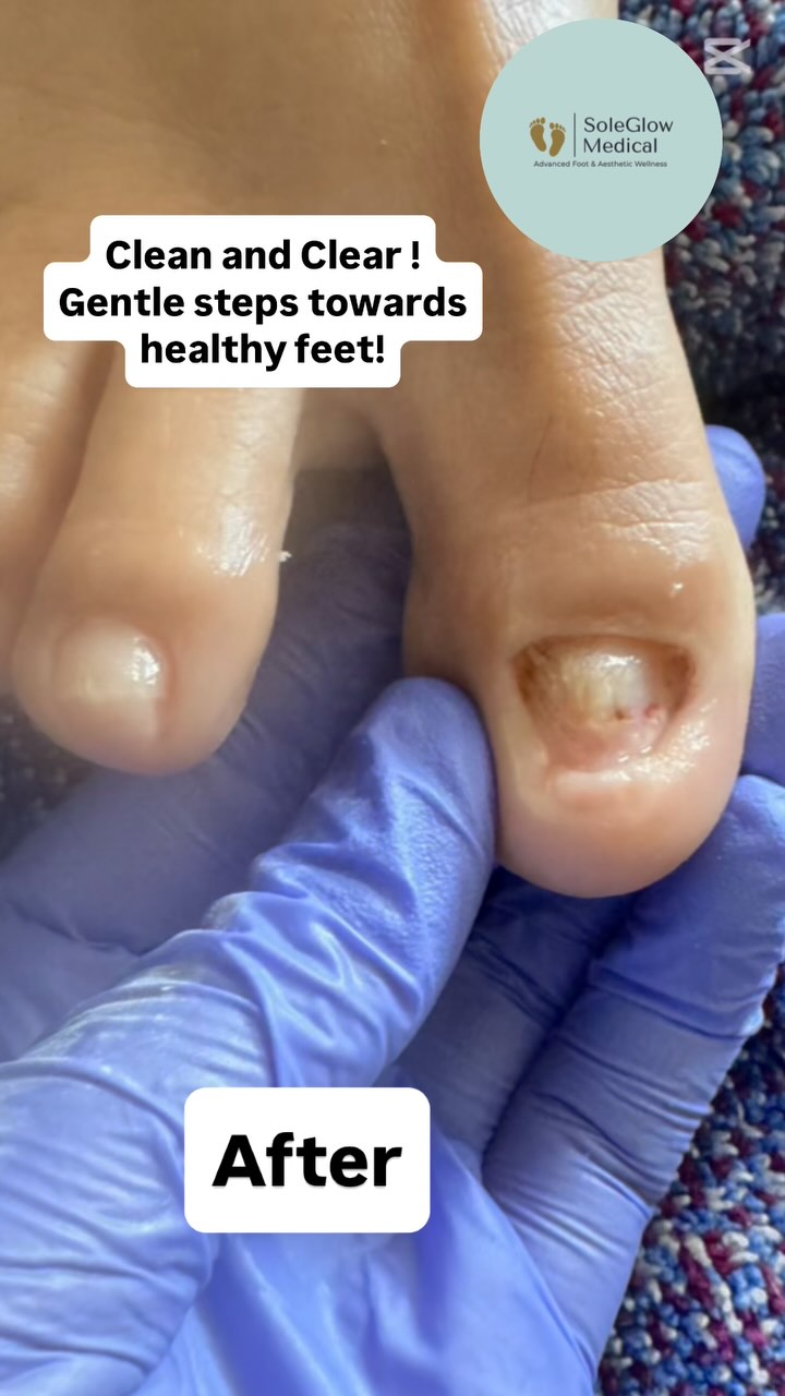 Today I met the sweetest client — all she wanted was to wear her flip-flops this summer without feeling embarrassed about her toenails. 🩴
After her foot care treatment was complete, she looked at her feet, smiled wide, gave me a hug, and said,
“I feel so good… now I can finally wear my flip-flops!” 🌞💖
Moments like these truly melt my heart. This is why I do what I do.
If you’re someone who feels shy, uncomfortable, or unsure about your feet — you’re not alone.
✨ There’s no judgment here. Just gentle, skilled, medical foot care that puts your comfort first.
📞 Call or text me - 780-655-5084
Let’s get your feet ready for flip-flop season.
#FootCareWithHeart #SoleGlowMedical #FlipFlopReady #FootCareNurse #MedicalFootCare #BeforeAndAfter#mobilefootcare #footcarenurse #healthyfeet #healthyfeethappylife