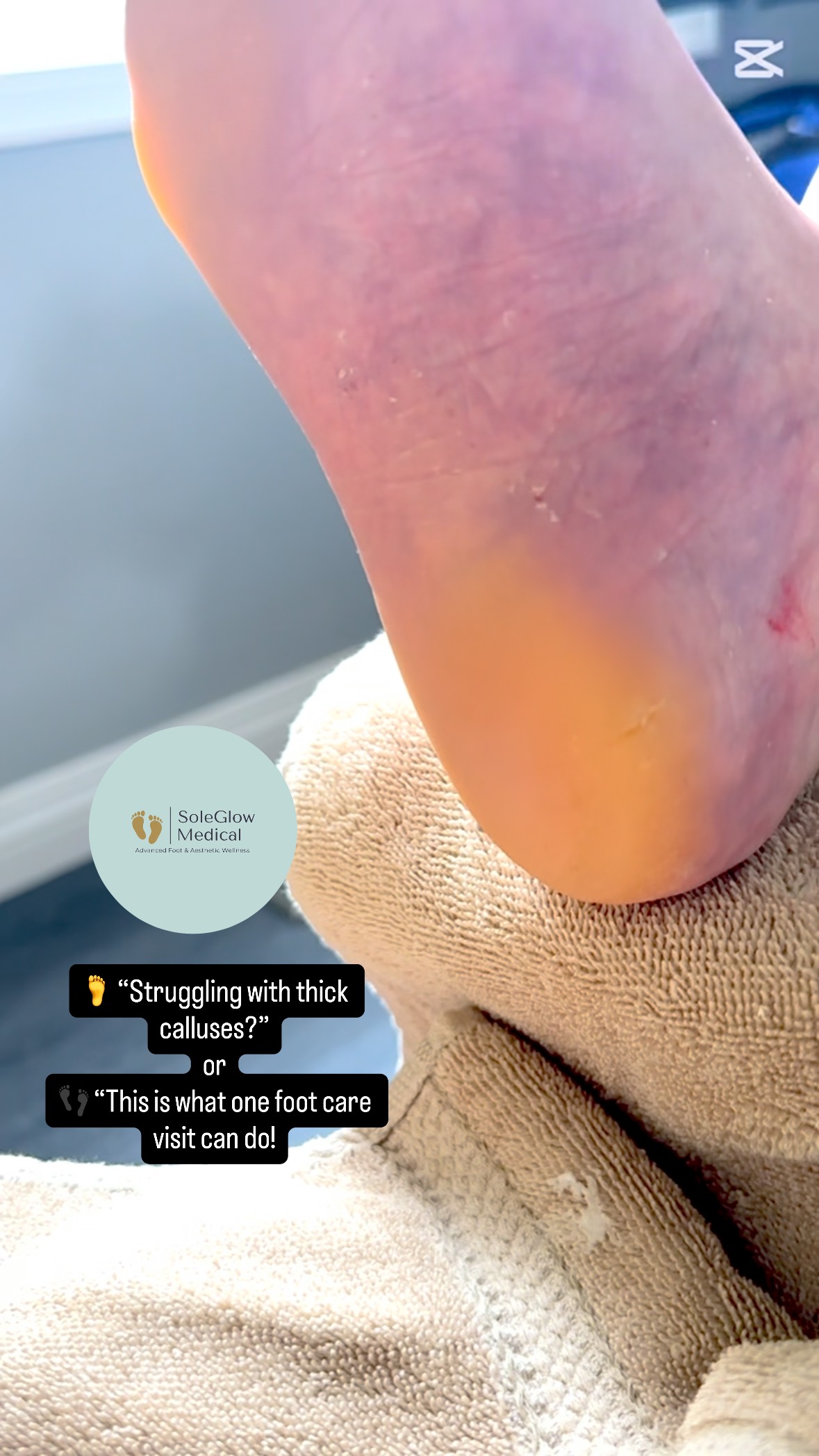👣 Callused feet? You’re not alone.
One visit = a visible difference and major relief!
Using medical-grade tools and gentle debridement, we helped restore comfort and confidence — all in just one session. 💫
📍 Mobile Foot Care | Edmonton
📞 Book now: 780-655-5084
#FootCare #CallusRemoval #SoleGlowResults #NurseLedCare #BeforeAndAfter