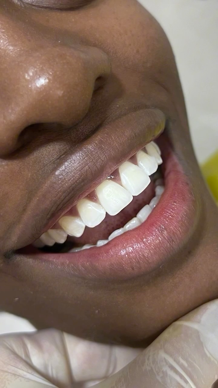 Clareamento dental seguro, respeitando a saúde do dente e realçando a beleza do sorriso.
Porque sorriso branco é lindo... mas sorriso saudável é essencial.
Quem aqui sonha em clarear os dentes de forma natural e saudável? 🙋♀️